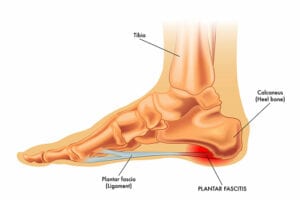 Plantar Fascitis Rszd Plantar Fascitis Rszd