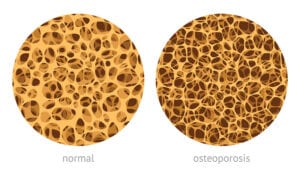 Osteoporosis Physicaltherapy Osteoporosis Physicaltherapy